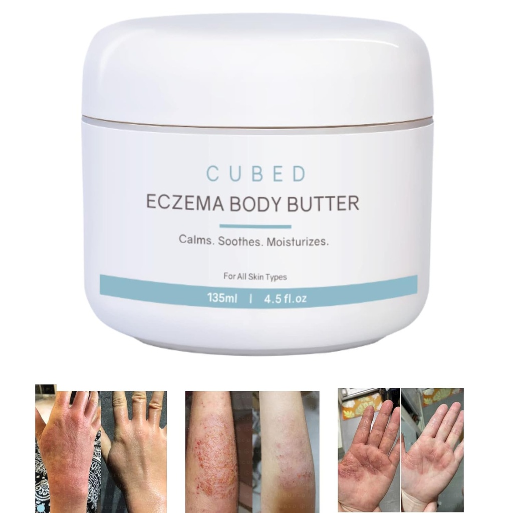 Cubed 4,5 oz Eczema Krem for voksne, Eczema Relief, Eczema behandling, moisturize tørr irridert hud, Smart lotion for emne steroid uttak symptomer, psoriasis & rosacea, Eczema, Dermatitis